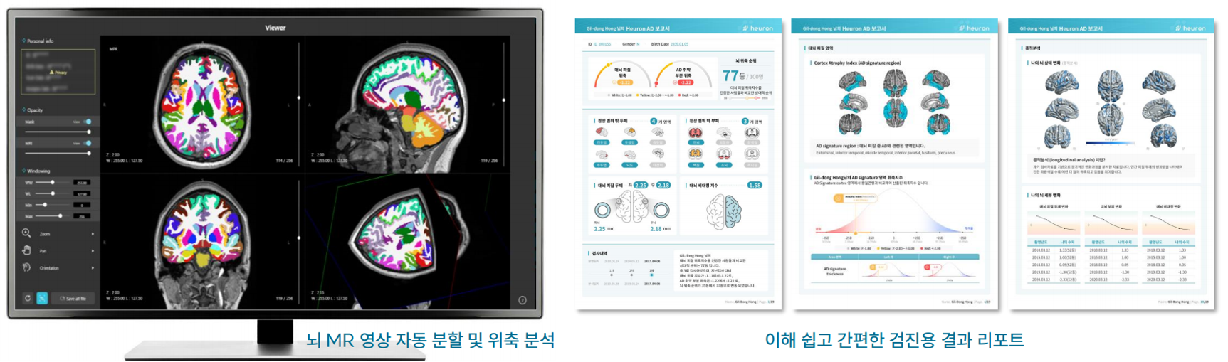 VIP건강증진센터, 뇌MRI와 인공지능 활용해 알츠하이머, 파킨슨 조기진단 도입