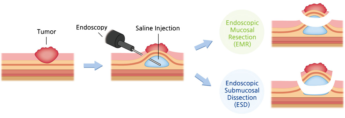 Endoscopic Resection