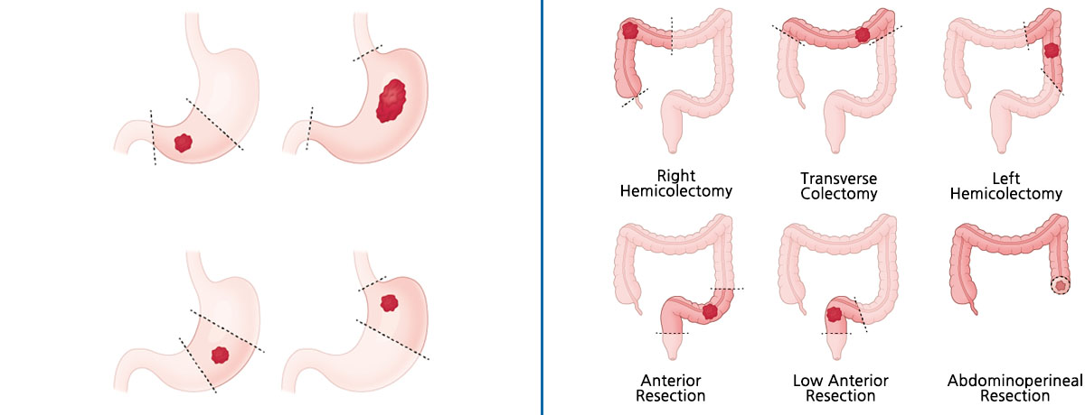 Gastric Cancer & Colorectal Cancer
