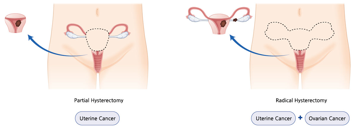 Uterine Cancer