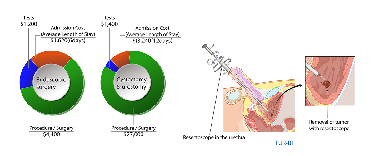 Bladder Cancer
