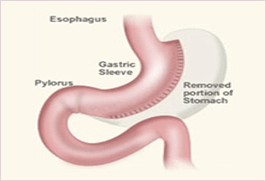 Laparoscopic Vertical Sleeve Gastrectomy image